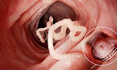 How to recognize the presence of pests in the human intestines